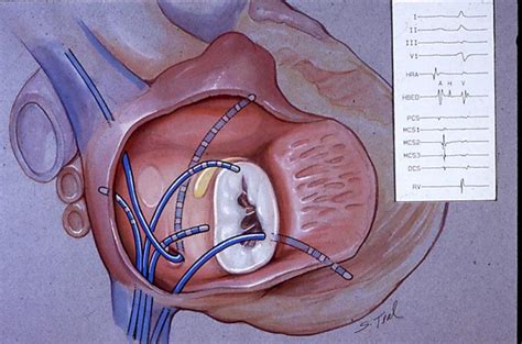 electrophysiology arrhythmia near occidental|Electrophysiology and Arrhythmias .